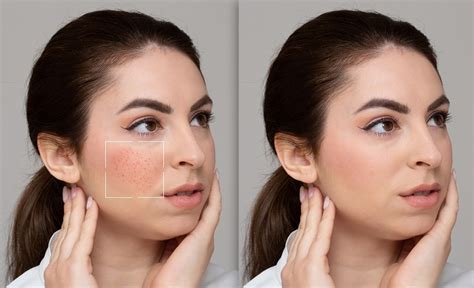 Ilustračná fotografia zobrazujúca unavenú pleť, ktorá potrebuje rozjasniť