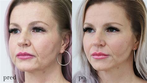 porovnanie tváre pred a po aplikácii botoxu