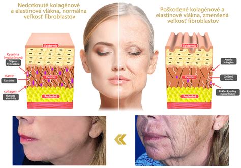 Schéma znázorňujúca pôsobenie technológie Co-Bonding na kolagénové vlákna v pleti
