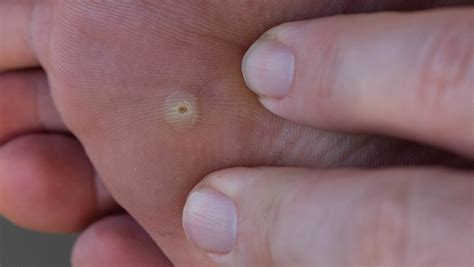 Ilustrácia porovnávajúca vzhľad kurieho oka a bradavice s vyznačenými charakteristickými znakmi.