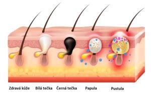 Ilustrácia rôznych typov akné (papuly, pustuly, komedóny)