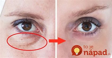 Ilustrácia tváre s viditeľnými tmavými kruhmi a opuchmi pod očami.