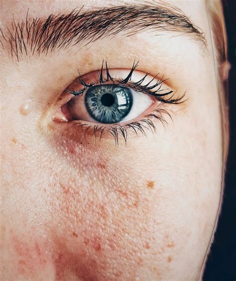 Ilustračná fotografia ženy s mastnou pleťou, zvýrazňujúca lesk a rozšírené póry