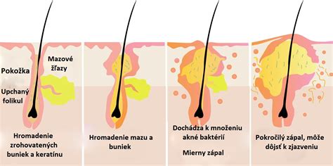 Schematické znázornenie vzniku akné v upchatom póre