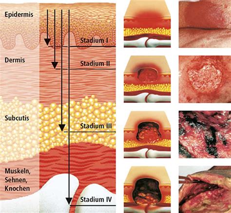 Ilustrácia dekubitu tretieho štádia s hlbokou ranou a odumretým tkanivom