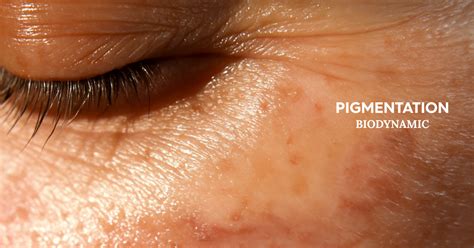 Ilustračné foto starnúcej pokožky s viditeľnými vráskami a pigmentovými škvrnami