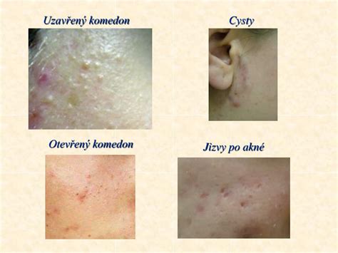 Schéma rôznych typov akné lézií (komedóny, papuly, pustuly, noduly, cysty)