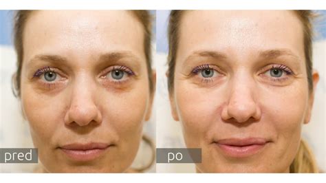 porovnávacia fotografia pokožky pred a po aplikácii peelingových procedúr