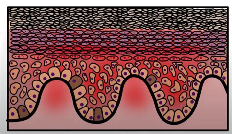 Ilustrácia mikroskopického pohľadu na psoriatickú kožu s rýchlo sa deliacimi bunkami a zápalovými infiltrátmi