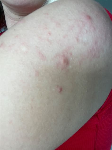 Príklad vyrážky pri pásovom opare na hrudníku