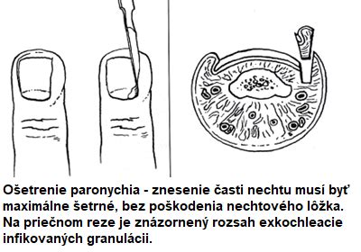 ilustrácia správneho ošetrenia rany