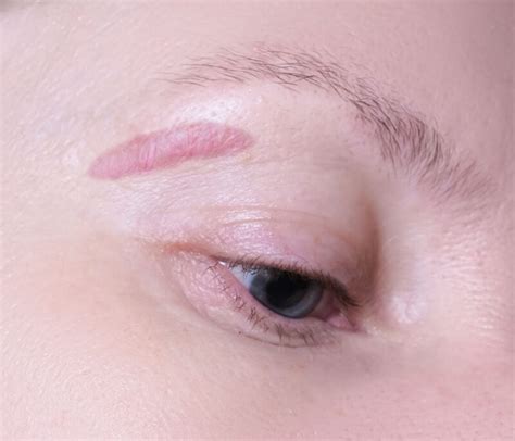 vizualizácia laserového ošetrenia jazvy