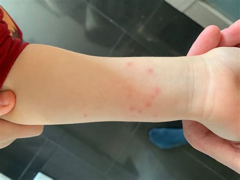 ilustrácia motýľovitej vyrážky na líciach dieťaťa