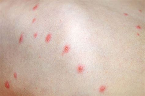 Infografika znázorňujúca priebeh vírusu varicella-zoster v tele.