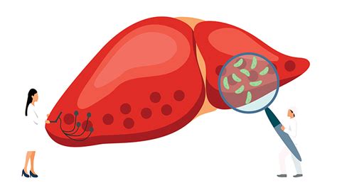 Schematické znázornenie pečene s rôznymi typmi hepatitídy