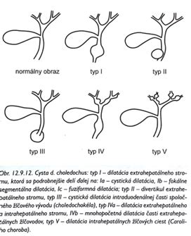 Ilustrácia žlčových ciest s možnou obštrukciou