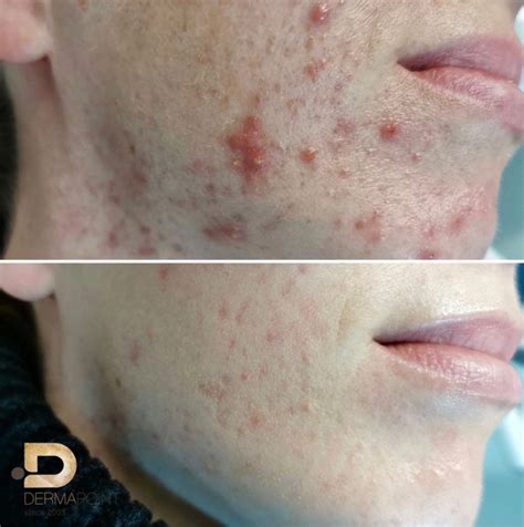 Obrázok s rôznymi typmi náplastí na akné a bodových ošetrení