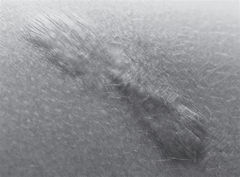 koláž rôznych typov jaziev: keloidná, hypertrofická, atrofická a strie