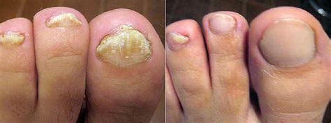 Ilustračná fotografia chodidiel s viditeľnými príznakmi nechtovej mykózy