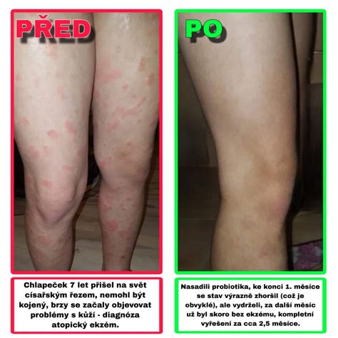 Schéma znázorňujúca typické lokalizácie atopického ekzému v rôznych vekových obdobiach