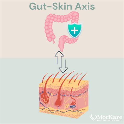 Ilustrácia znázorňujúca prepojenie čreva a kože (gut-skin axis)