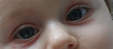 Ilustračná fotografia dieťaťa s jemným začervenaním okolo očí.