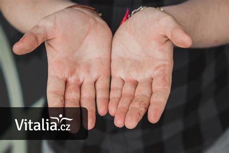 Detailný záber na malé pľuzgieriky na prstoch ruky, typické pre dyshidrotický ekzém.