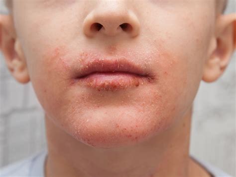 Koláž fotografií ukazujúca rôzne prejavy ekzému u detí rôzneho veku.