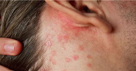 Fotografia pokožky postihnutej atopickou dermatitídou