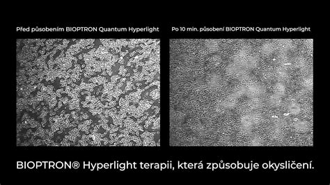 Ilustrácia porovnávajúca vzhľad suchej a dehydrovanej pleti pod mikroskopom.