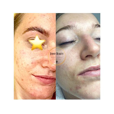 Schéma znázorňujúca rozdiel medzi mechanickým a chemickým peelingom