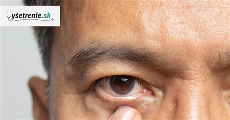 Ohraničené ložisko sčervenania a šupinatenia, ktoré môže signalizovať plesňovú infekciu.