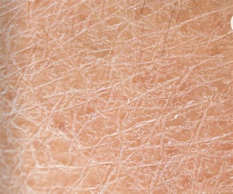 detailný záber na kožu postihnutú ekzémom