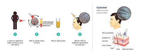 infografika o mechanizme účinku PRP terapie