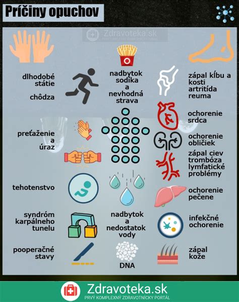 Ilustrácia opuchnutých prstov pri daktylitíde