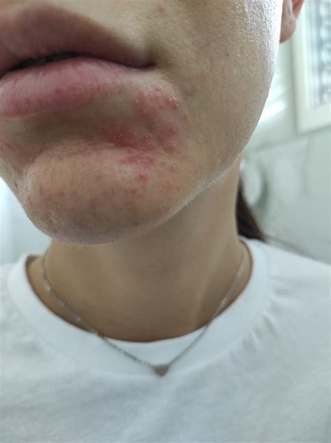 Ilustrácia tváre so začervenaním a vyrážkami v okolí úst, typické pre perorálnu dermatitídu.