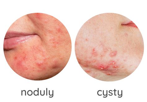 Koláž obrázkov znázorňujúcich rôzne typy akné: čierne bodky, biele bodky, papuly, pustuly, noduly a cysty.