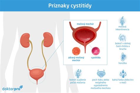 Ilustrácia znázorňujúca rôzne časti tela, kde sa môže vyskytnúť mykóza u mužov (genitálie, chodidlá, koža)