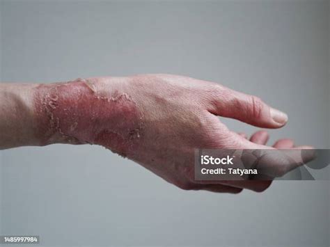 Detail fotografie ruky s vyrážkami v mieste kontaktu s alergénom (napr. šperkom)