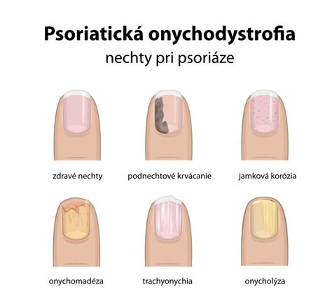 Ilustrácia rôznych foriem psoriázy na koži a nechtoch