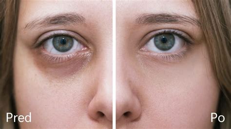 ilustrácia kruhov pod očami a ich možných príčin