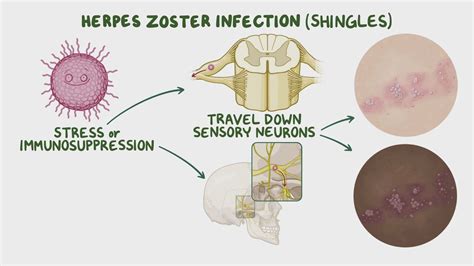 Schéma nervového zakončenia postihnutého vírusom herpes zoster