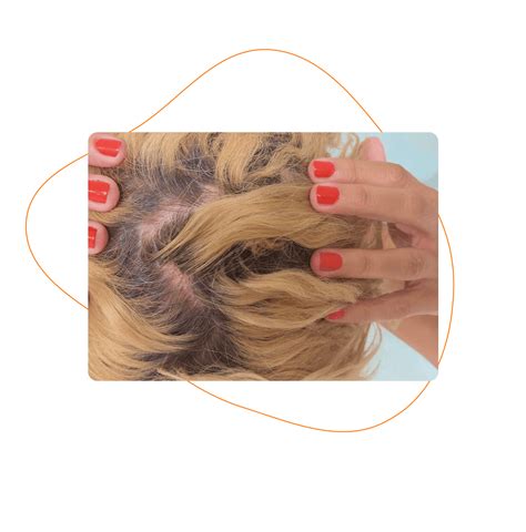 Ilustrácia zobrazujúca rôzne štádiá vypadávania vlasov pri alopécii areata, vrátane okrúhlych lysín a rednutia vlasov.