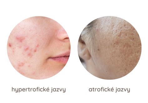 Schéma zobrazujúca rôzne typy jaziev po akné (jamkové, keloidné, hypertrofické)