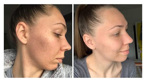 Ilustrácia pôsobenia IPL svetla na pokožku pri rôznych problémoch (vrásky, akné, pigmentácie)