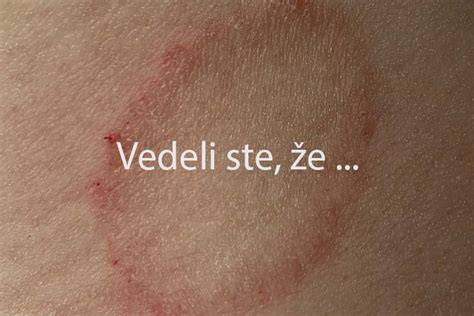 ilustrácia plesňovej infekcie na koži