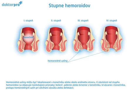 Ilustrácia vnútorných a vonkajších hemoroidov