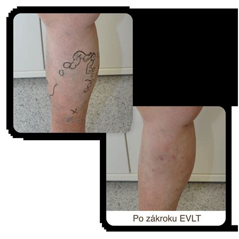 Ilustrácia ambulantného zákroku