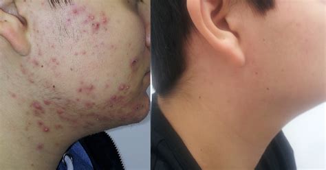 Schéma vzniku akné od mikrokomedónu po zápalové prejavy