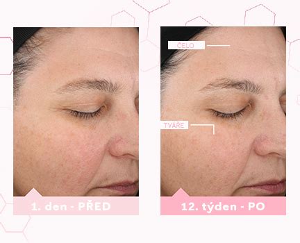 porovnanie pleti pred a po použití depigmentačného séra